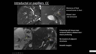 Cholangiocarcinoma [upl. by Rudolfo500]