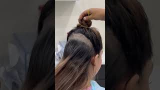 Female hair transplant  Dadu Medical Centre  Dr Nandni Daddu [upl. by Sukey287]