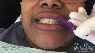 Color Ties on Clear Braces  Boca Raton Orthodontist [upl. by Neyut94]