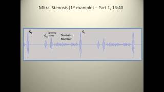 Examples of mitral stenosis murmurs [upl. by Ebner]