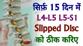 L4  L5  S1 Slipped Disc Treatment  Cure Slipped Disc  Herniated Disc In 15 Days [upl. by Levania]