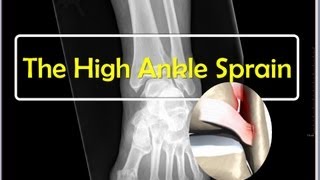 The High Ankle Sprain [upl. by Nizam]