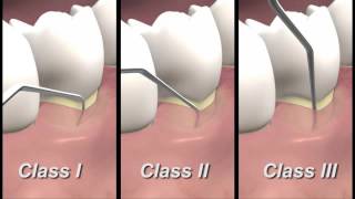 Periodontal Examination Burnaby Vancouver Periodontist IMPrESS Perio Dr Mehdi Noroozi [upl. by Hniht754]