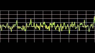 Cluster Headaches  Rife Frequencies [upl. by Nwahsyd]