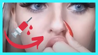 Lippen aufspritzen mit Hyaluronsäure 💉  lippen massieren nach aufspritzen [upl. by Elin]