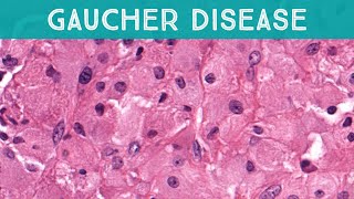 Gaucher disease involving bone lysosomal storage disorder glucocerebrosidase deficiency pathology [upl. by Marte]