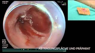 Karzinom im Barrett Ösophagus EMR und RFA [upl. by Aisetal]