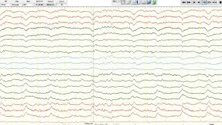 EEG Ictalinterictal continuum [upl. by Kurth]