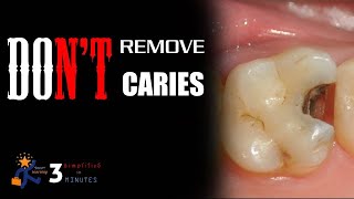 Caries removal technique [upl. by Doley]