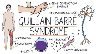 Understanding GuillainBarré Syndrome [upl. by Alyl]