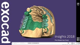 INSIGHTS 2018 PartialCAD Case Demonstration  Bridge with attachments and partial Part II [upl. by Moncear952]