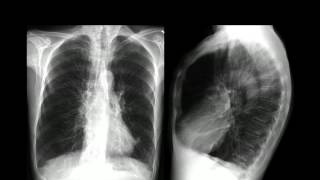 ENFISEMA PULMONAR [upl. by Tobit]