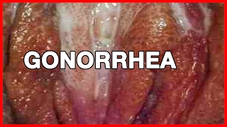 Gonorrhea in Men Symptoms Signs and Health Risks [upl. by Wamsley367]