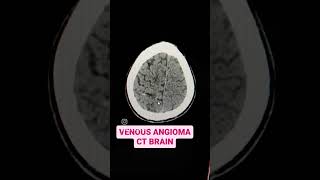 Venous Angioma CT Brain Explained [upl. by Onaicilef]