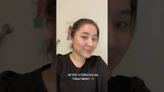 Watch to see the this Hydrafacial Before amp After results shorts hydrafacial facial tratment [upl. by Palermo575]