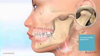 Carriere® Motion™ Appliance for Class II Patient Education Animation 2 [upl. by Dnalevelc]