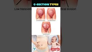 C Section Secrets Revealed ✅ Pregnancy Delivery option  Painless delivery option  Cesarean Section [upl. by Ynaffad]