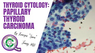 Thyroid Cytology Papillary Thyroid Carcinoma [upl. by Emmett]