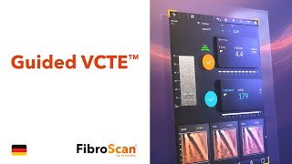 Guided VCTE™  FibroScan® [upl. by Gautious]