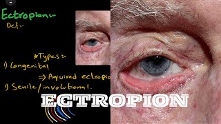 What is ectropion  And it’s types  causes  symptoms  grades and treatment [upl. by Helbonna]