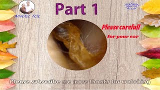 Why Do We Have Earwax Diagnosis and Treatment Part1 [upl. by Kcirttap738]