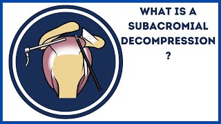 What is a subacromial decompression [upl. by Yadseut78]