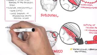 Intracranial Haemorrhage Types signs and symptoms [upl. by Akirdnahs]