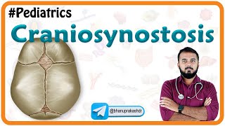 Craniosynostosis  Types Causes Diagnosis and Treatment  Pediatrics National exit test [upl. by Lorianne881]