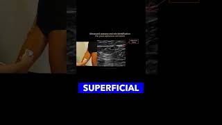 Identifying the Great Saphenous Vein vascularultrasound healthcareexcellence MedicalEducation [upl. by Deach505]