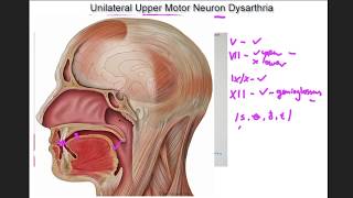 Unilateral Upper Motor Neuron Dysarthria  example and tutorial [upl. by Mccarthy963]