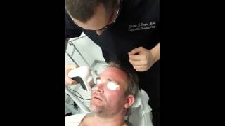 QuadroStar Pro Yellow Laser For Rosacea and Facial Redness  Clear  Brilliant in Men [upl. by Eyllek599]