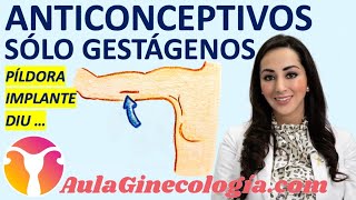 ANTICONCEPTIVOS SÓLO GESTÁGENOS ASG PÍLDORA IMPLANTE DIU INYECTABLE Ginecología y Obstetricia [upl. by Ayala]