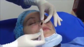 Rinoplastia con hilos tensores [upl. by Ulrica]