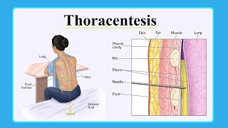 thoracentesis [upl. by Rauscher]