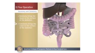 ColostomyIleostomy Your Operation [upl. by Thurstan]