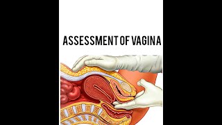 vaginal examination [upl. by Ilram]