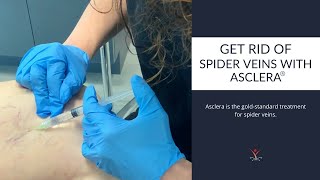 The Gold Standard Spider Vein Treatment [upl. by Yelsnik511]