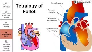 Cyanotic Congenital Heart Diseases [upl. by Dnomse]