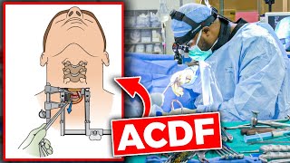 Anterior Cervical Discectomy and Fusion ACDF [upl. by Tabber]