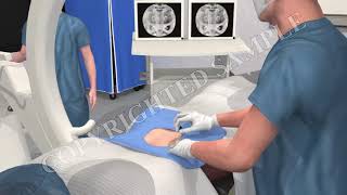 Epidural Steroid Injection  Surgical Procedure [upl. by Horlacher]