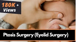 Ptosis Surgery Eyelid Surgery in Mumbai India by Best Oculoplastic Surgeon  Dr Debraj Shome [upl. by Laram]