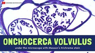 Onchocerca volvulus under the microscope with Massons trichrome stain [upl. by Kenay410]