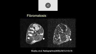 MRI of Soft Tissue Tumors  Part 2 [upl. by Nahej]