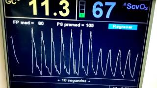 Monitoreo HEmodinámico con Swan Ganz y Vigileo en VAFO UCI las Américas [upl. by Poole497]