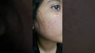 ADAPALENE gel for acne skincare acne [upl. by Adyan]