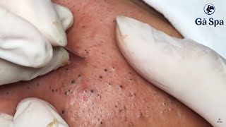 Best Blackhead Removal Ever 55min  Facial Acne Treatment  Gà Spa [upl. by Landrum307]