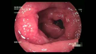 Double Balloon Enteroscopy in Crohns disease [upl. by Zahc]