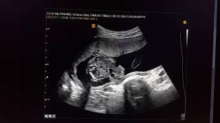 Gastroschisis Sonography [upl. by Prudie]