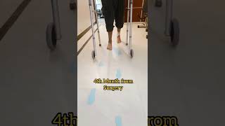 Height Increase Surgery  Walking After Limb Lengthening Surgery  Height Surgery heightincrease [upl. by Rudich202]