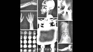 HEMATOLOGICAL MALIGNANCY  BONE CANCER [upl. by Neelyahs]